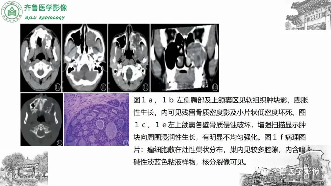 影像PPT - 【病例】上颌窦腺样囊性癌2例CT及MR影像鉴别-30
