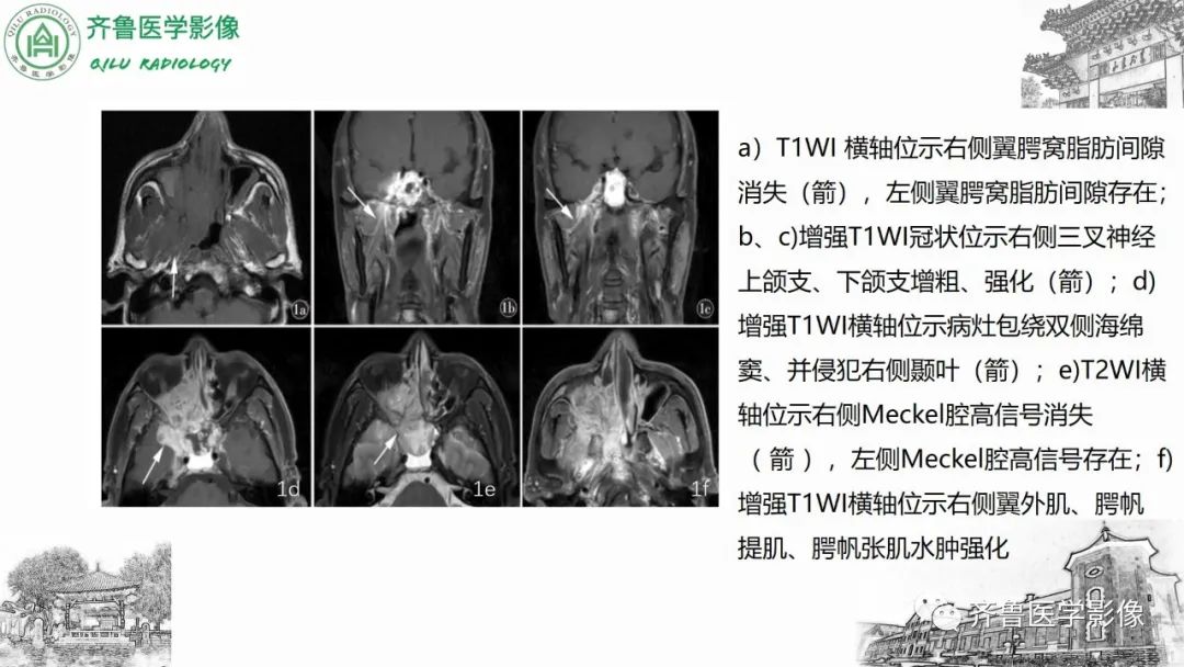 影像PPT - 【病例】上颌窦腺样囊性癌2例CT及MR影像鉴别-32