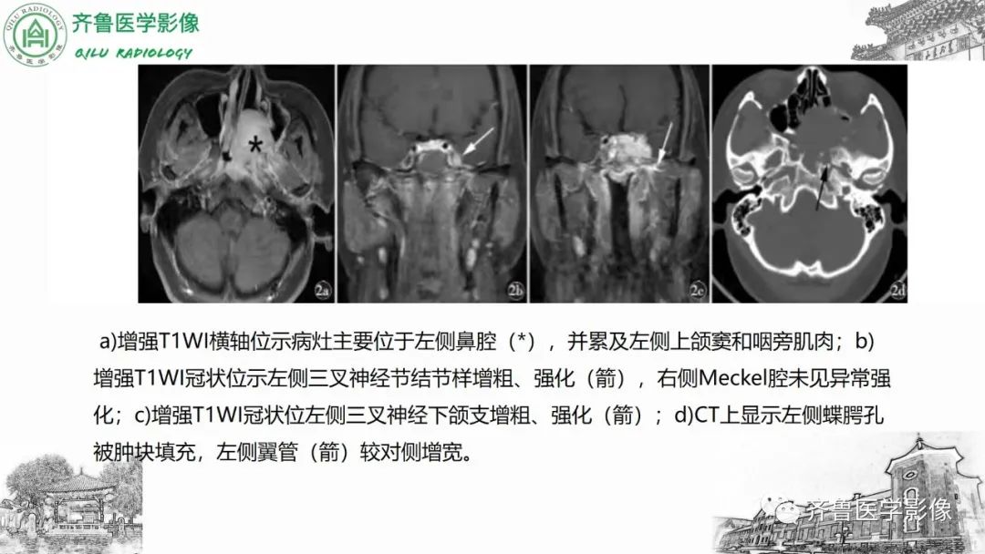 影像PPT - 【病例】上颌窦腺样囊性癌2例CT及MR影像鉴别-33