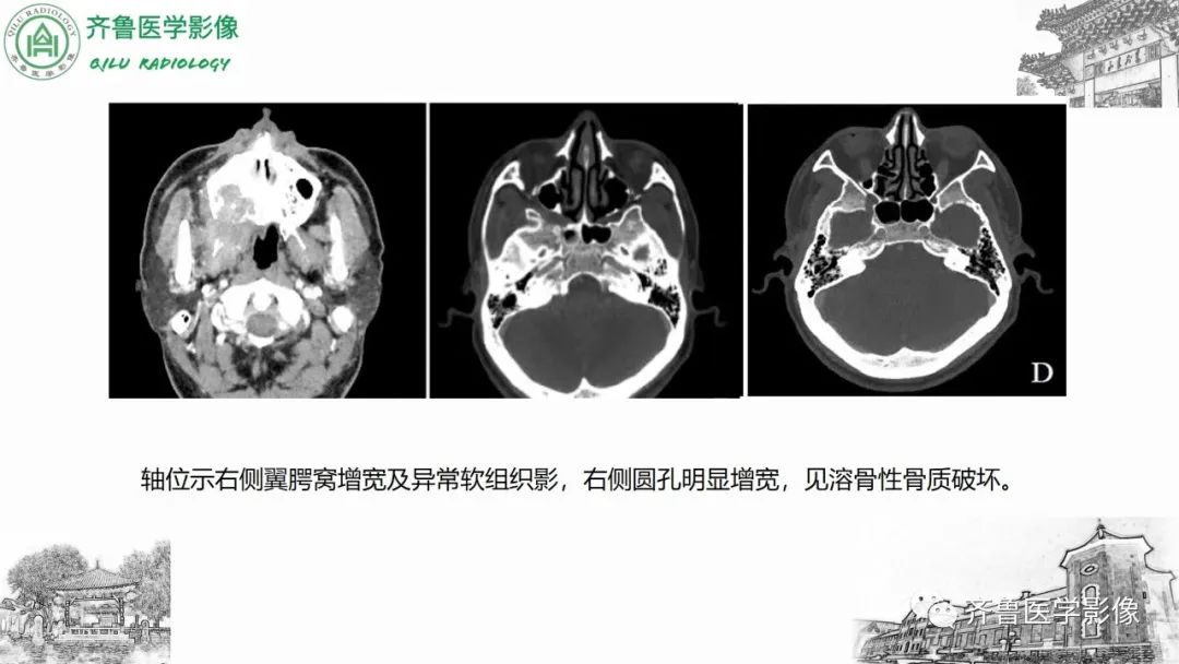 影像PPT - 【病例】上颌窦腺样囊性癌2例CT及MR影像鉴别-31