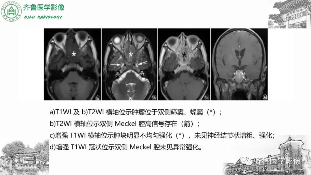 影像PPT - 【病例】上颌窦腺样囊性癌2例CT及MR影像鉴别-37