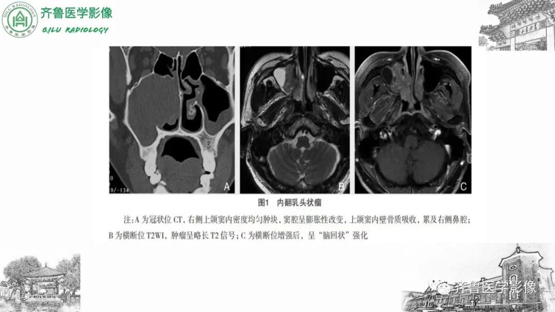 影像PPT - 【病例】上颌窦腺样囊性癌2例CT及MR影像鉴别-41