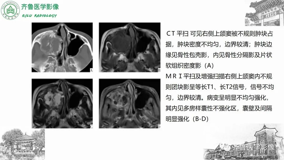 影像PPT - 【病例】上颌窦腺样囊性癌2例CT及MR影像鉴别-44
