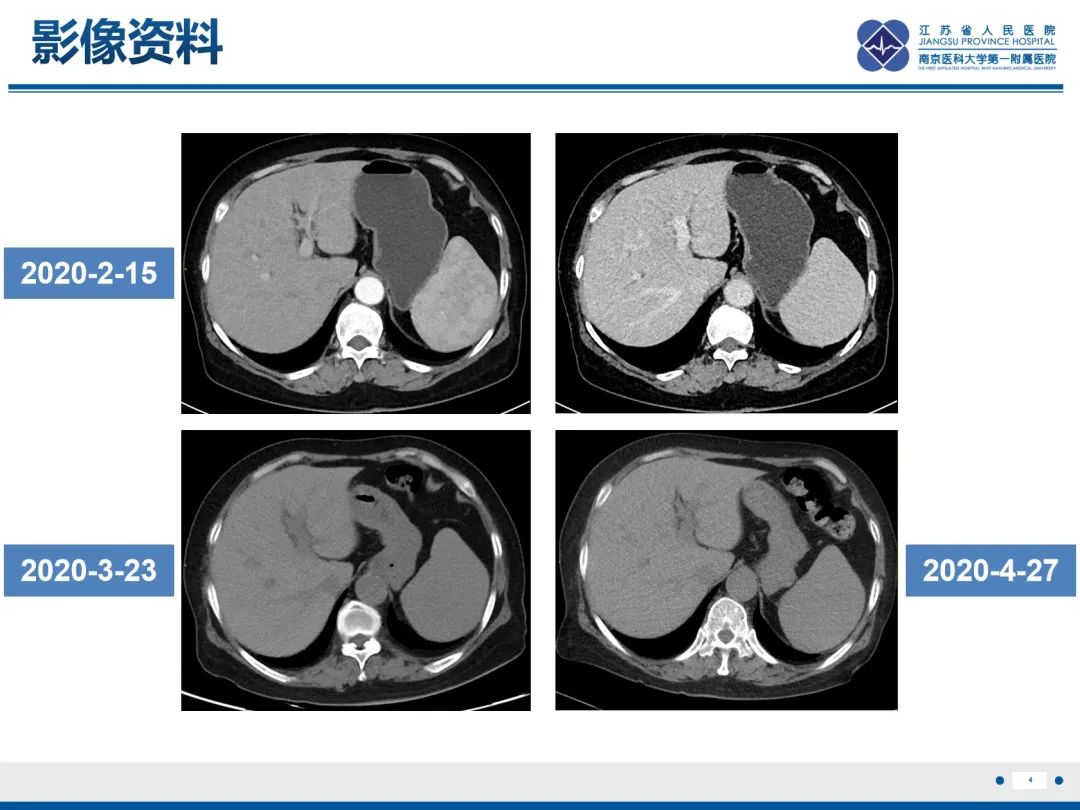 影像PPT - 【PPT】化疗相关性肝脂肪变性-5