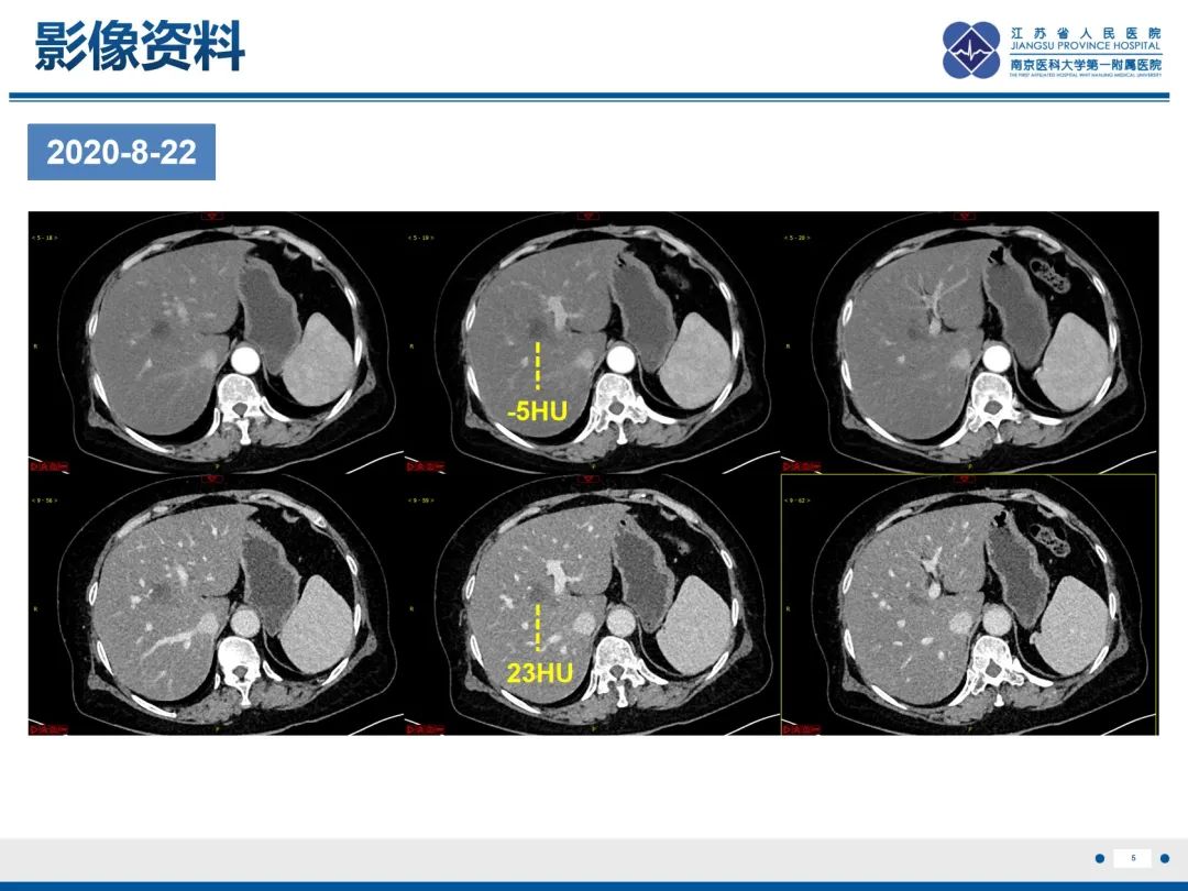 影像PPT - 【PPT】化疗相关性肝脂肪变性-6