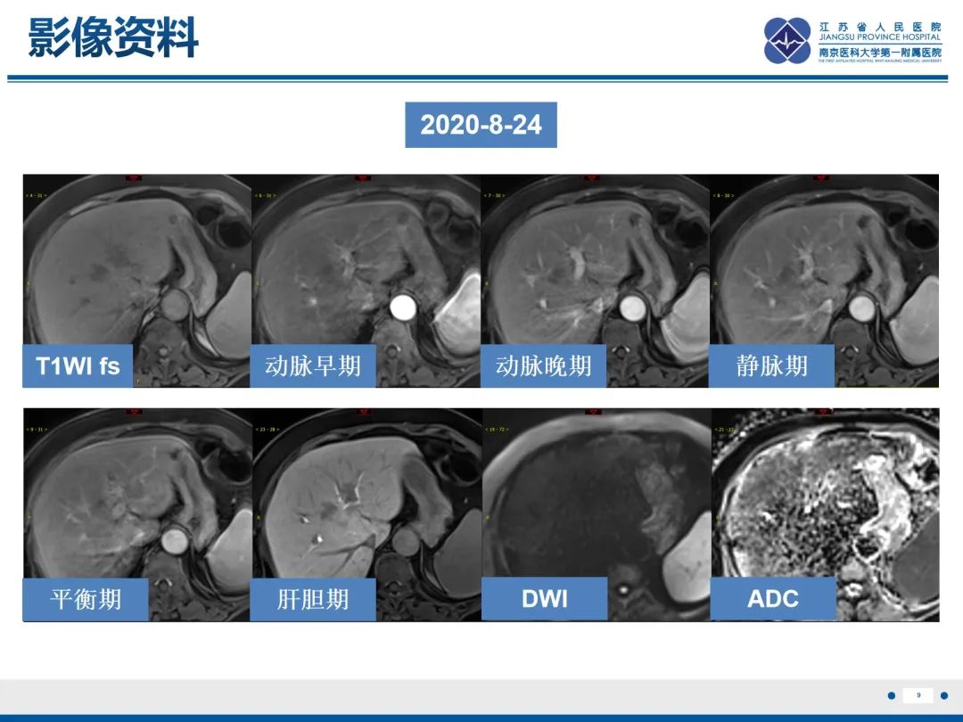 影像PPT - 【PPT】化疗相关性肝脂肪变性-10