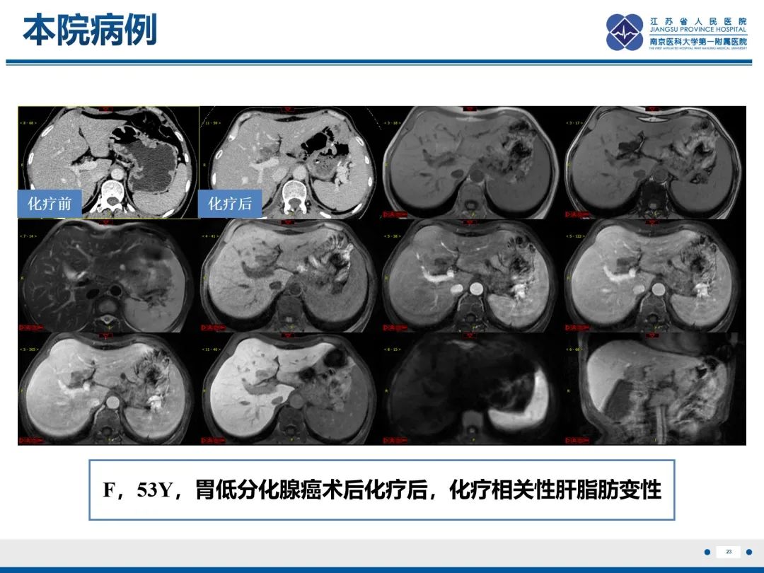 影像PPT - 【PPT】化疗相关性肝脂肪变性-24