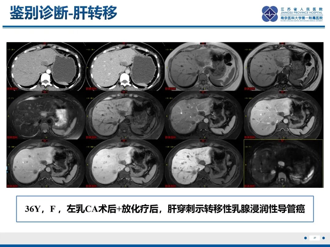 影像PPT - 【PPT】化疗相关性肝脂肪变性-28