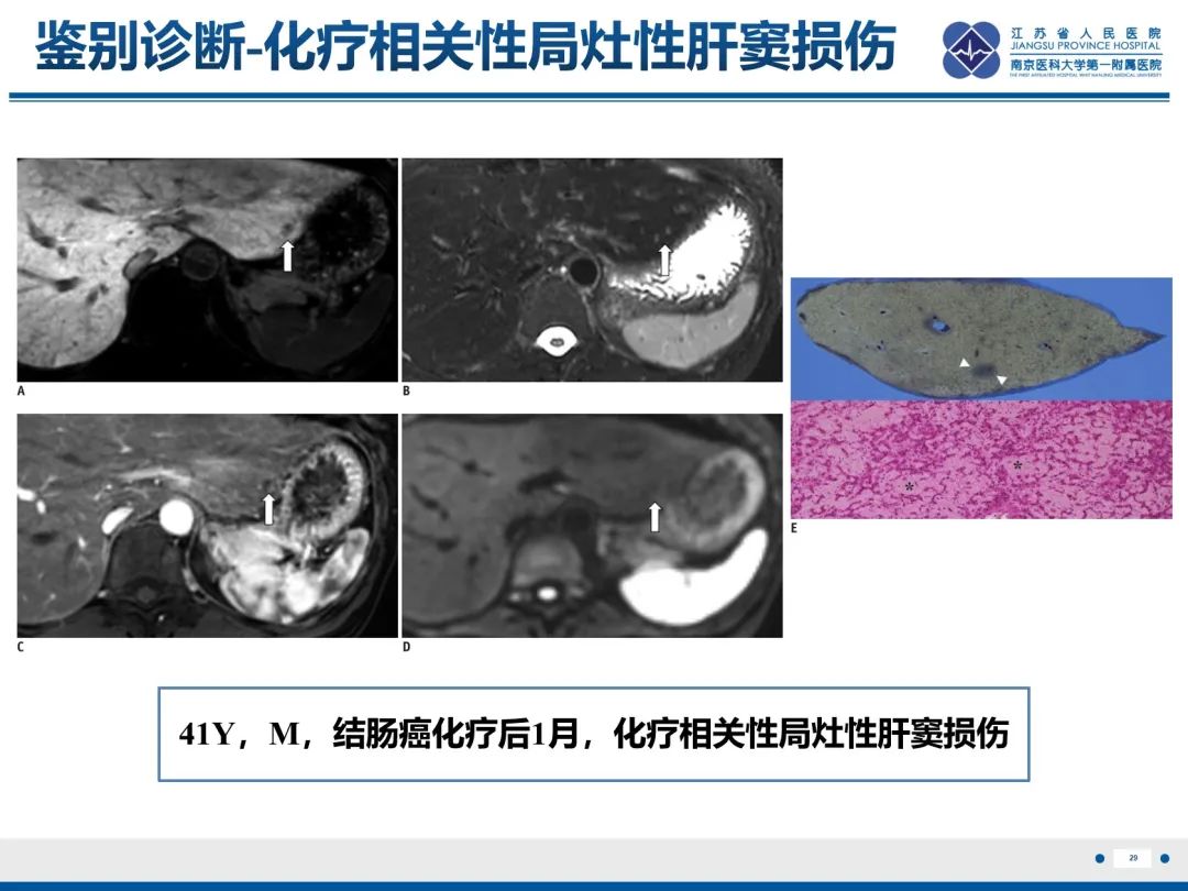 影像PPT - 【PPT】化疗相关性肝脂肪变性-30