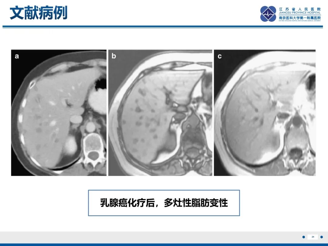 影像PPT - 【PPT】化疗相关性肝脂肪变性-25