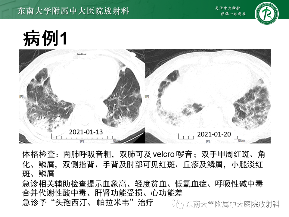 影像PPT - 【PPT】肺间质疾病相关影像鉴别-5