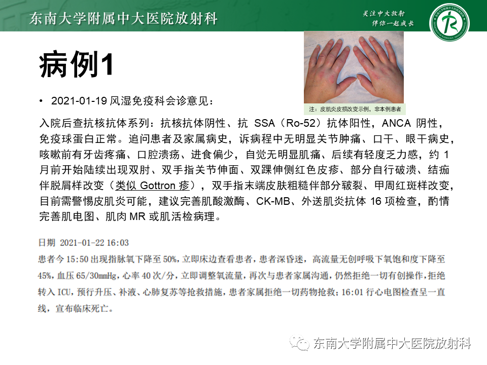 影像PPT - 【PPT】肺间质疾病相关影像鉴别-7