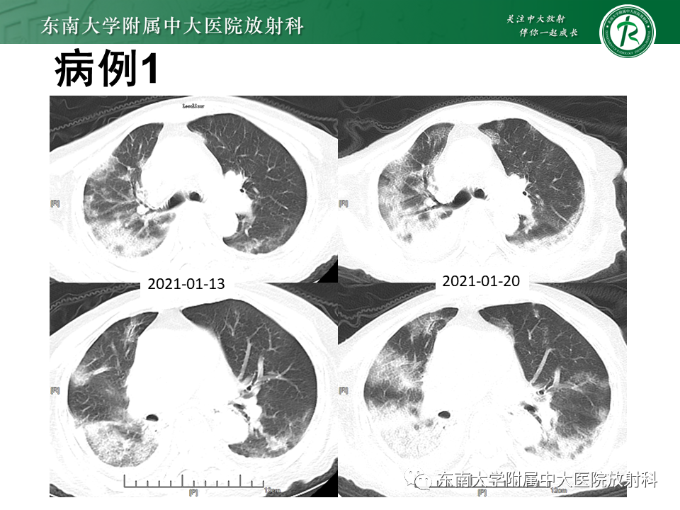 影像PPT - 【PPT】肺间质疾病相关影像鉴别-4