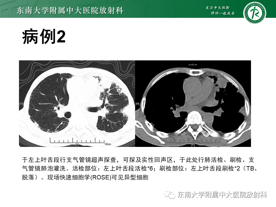 影像PPT - 【PPT】肺间质疾病相关影像鉴别-13