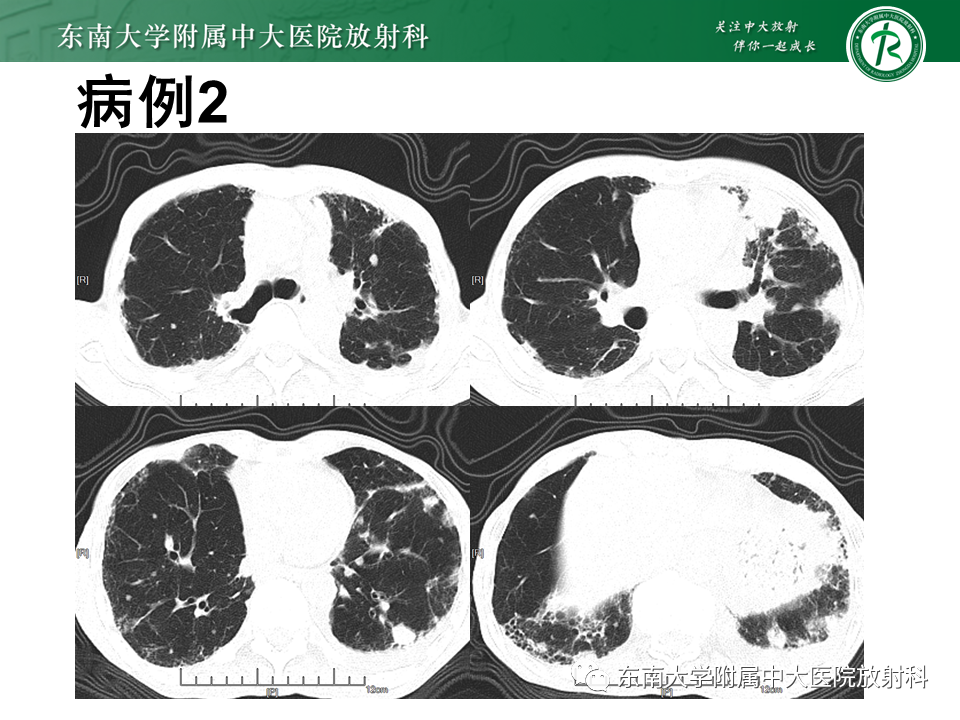 影像PPT - 【PPT】肺间质疾病相关影像鉴别-12