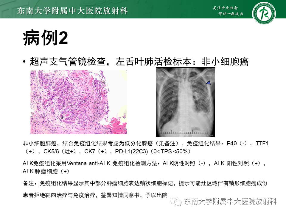 影像PPT - 【PPT】肺间质疾病相关影像鉴别-14