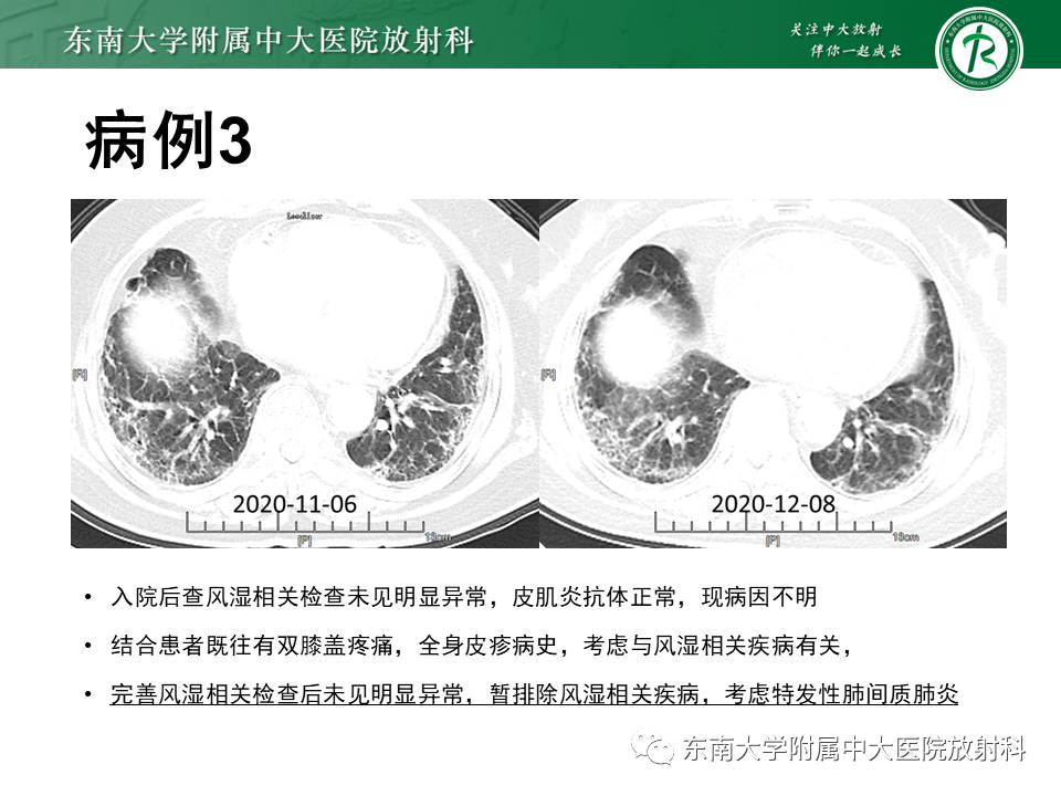 影像PPT - 【PPT】肺间质疾病相关影像鉴别-18
