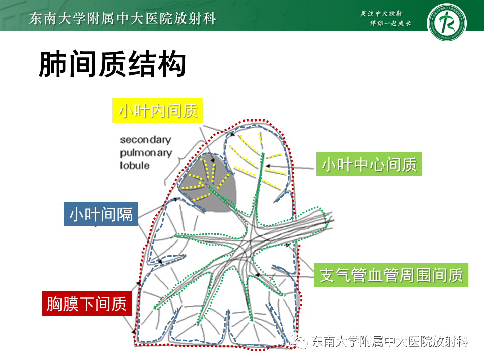影像PPT - 【PPT】肺间质疾病相关影像鉴别-21