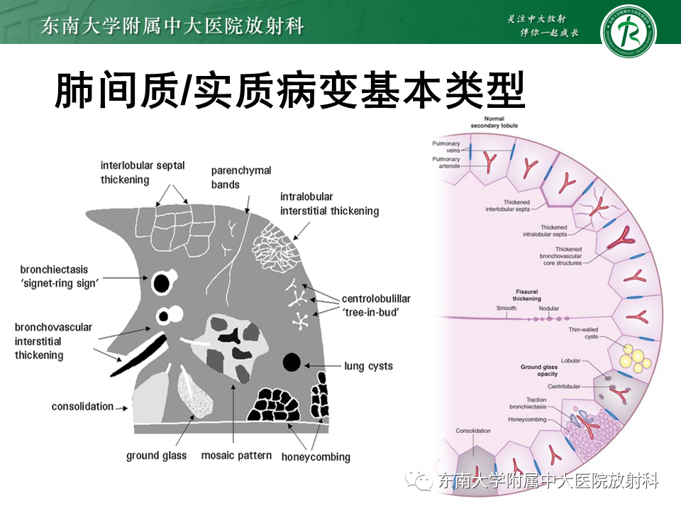 影像PPT - 【PPT】肺间质疾病相关影像鉴别-24