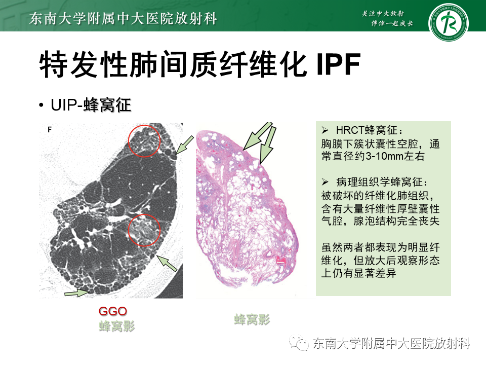 影像PPT - 【PPT】肺间质疾病相关影像鉴别-33