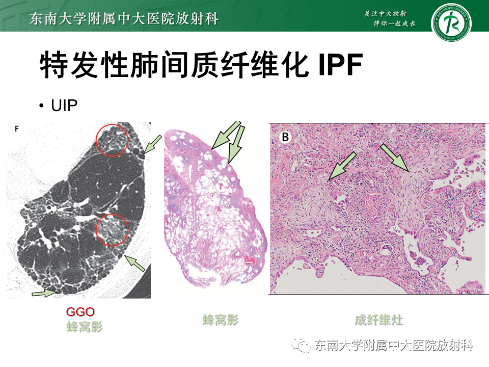 影像PPT - 【PPT】肺间质疾病相关影像鉴别-32