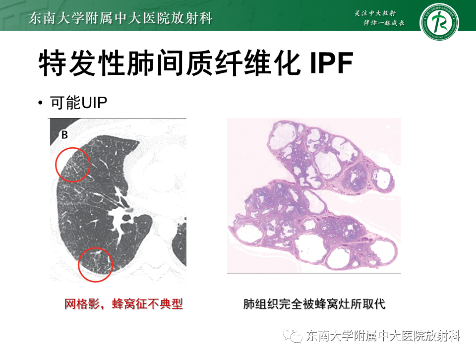 影像PPT - 【PPT】肺间质疾病相关影像鉴别-34