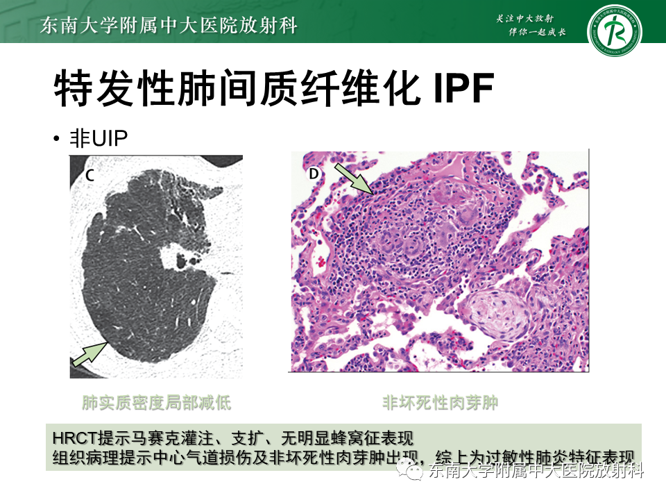 影像PPT - 【PPT】肺间质疾病相关影像鉴别-35