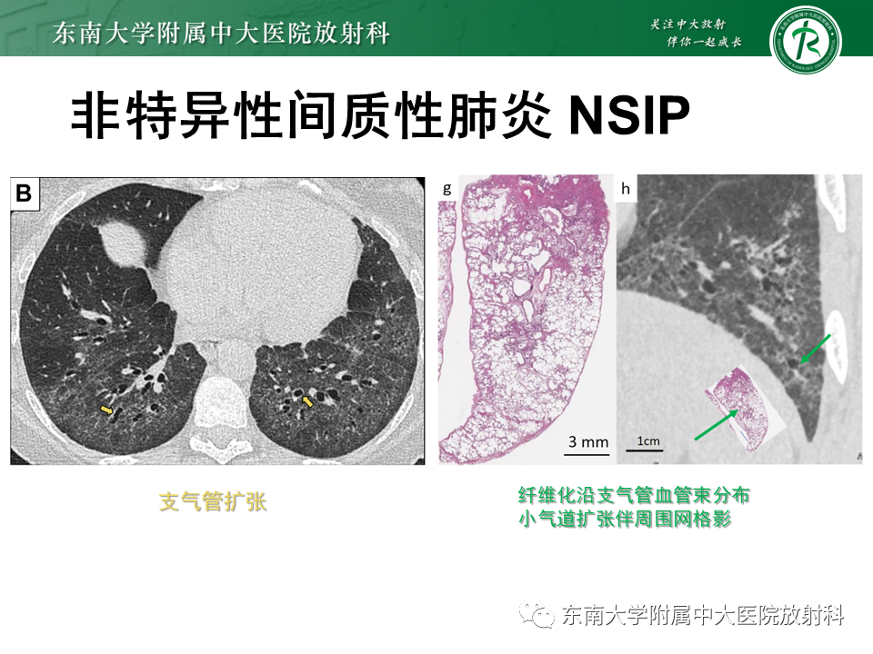 影像PPT - 【PPT】肺间质疾病相关影像鉴别-36