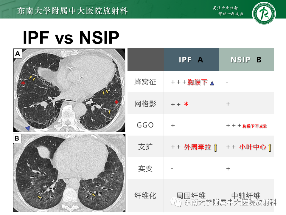 影像PPT - 【PPT】肺间质疾病相关影像鉴别-39