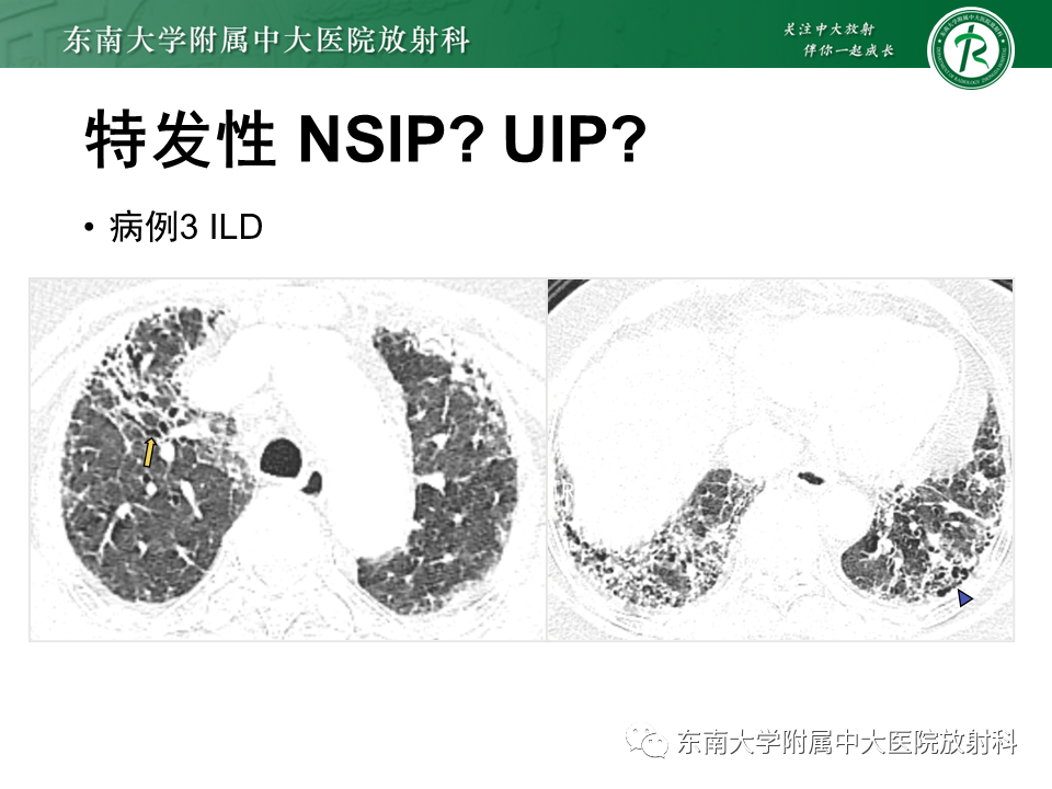影像PPT - 【PPT】肺间质疾病相关影像鉴别-41
