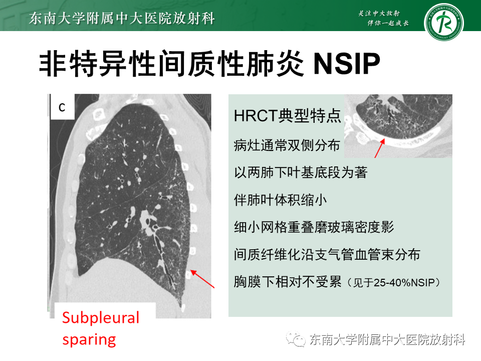 影像PPT - 【PPT】肺间质疾病相关影像鉴别-37