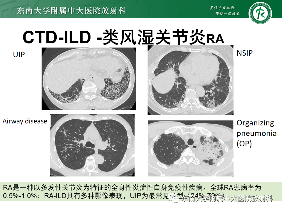 影像PPT - 【PPT】肺间质疾病相关影像鉴别-43
