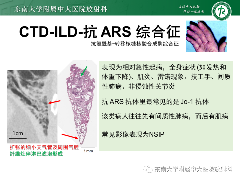 影像PPT - 【PPT】肺间质疾病相关影像鉴别-45