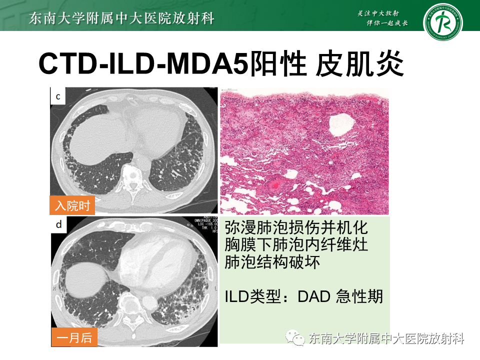 影像PPT - 【PPT】肺间质疾病相关影像鉴别-48