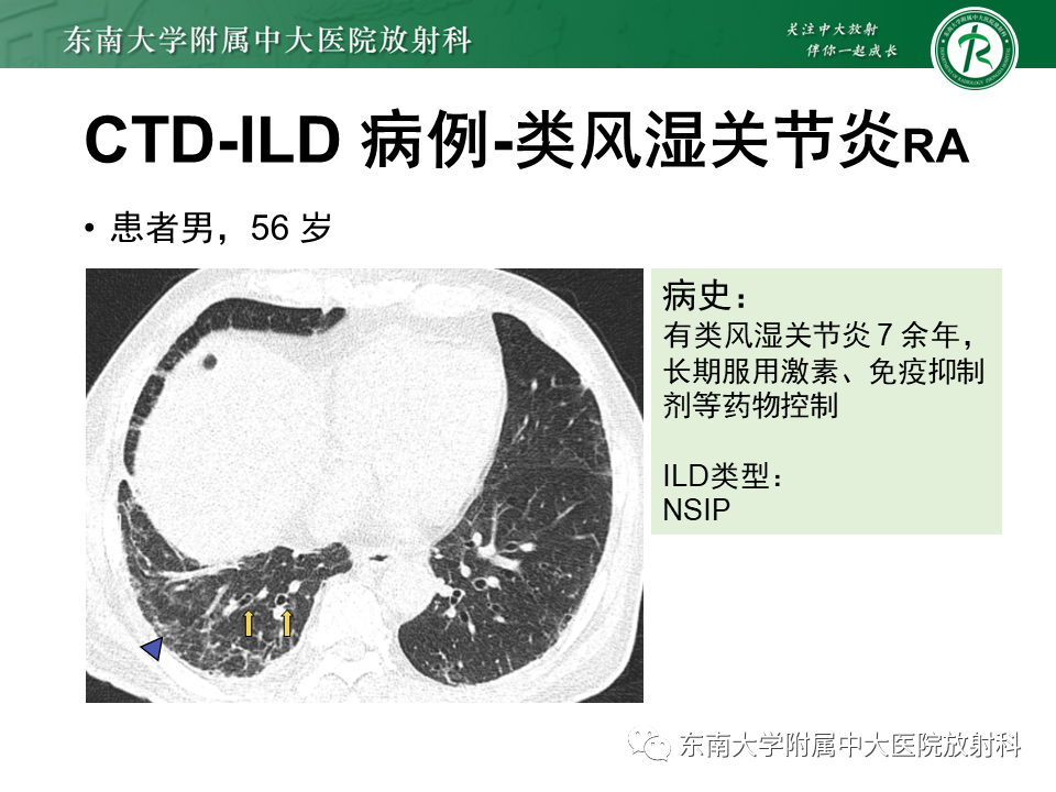 影像PPT - 【PPT】肺间质疾病相关影像鉴别-44