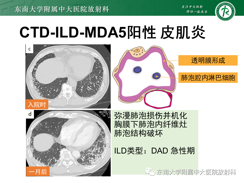 影像PPT - 【PPT】肺间质疾病相关影像鉴别-49