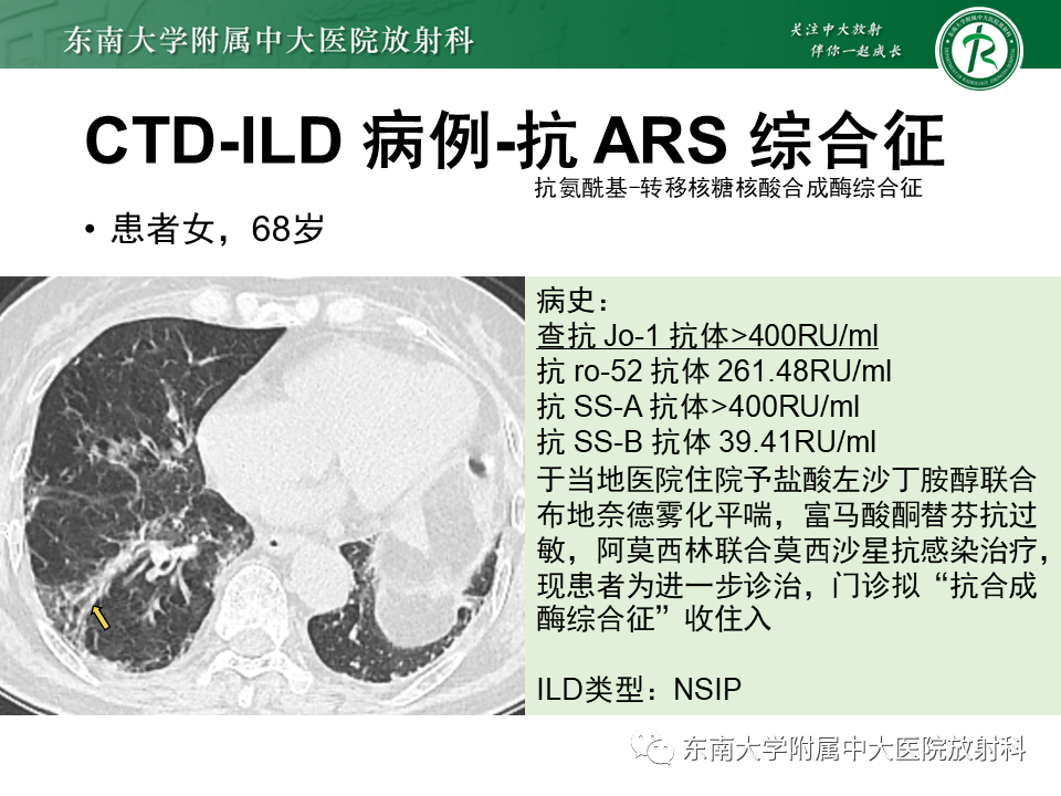 影像PPT - 【PPT】肺间质疾病相关影像鉴别-46