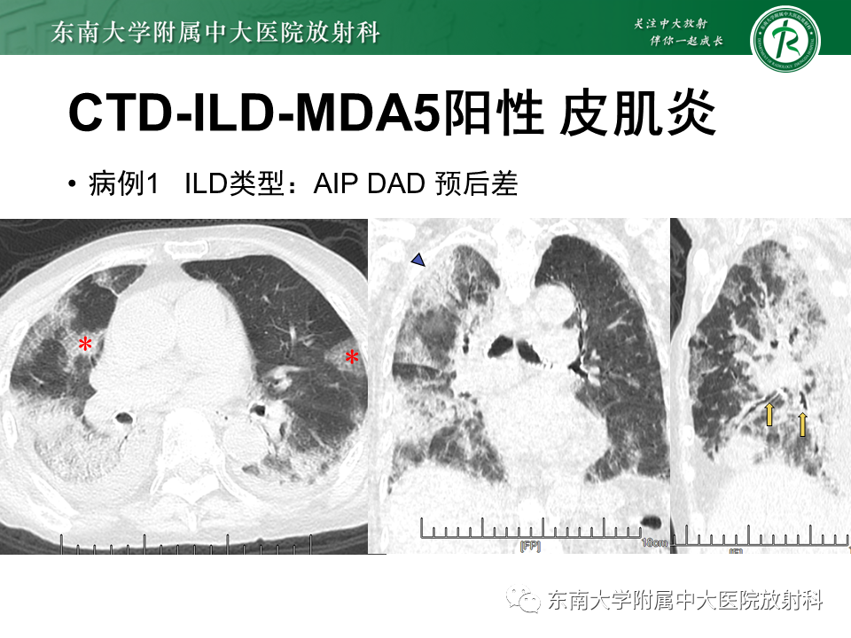 影像PPT - 【PPT】肺间质疾病相关影像鉴别-50