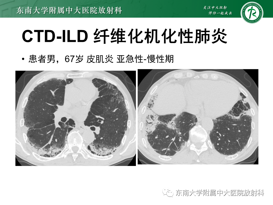 影像PPT - 【PPT】肺间质疾病相关影像鉴别-51