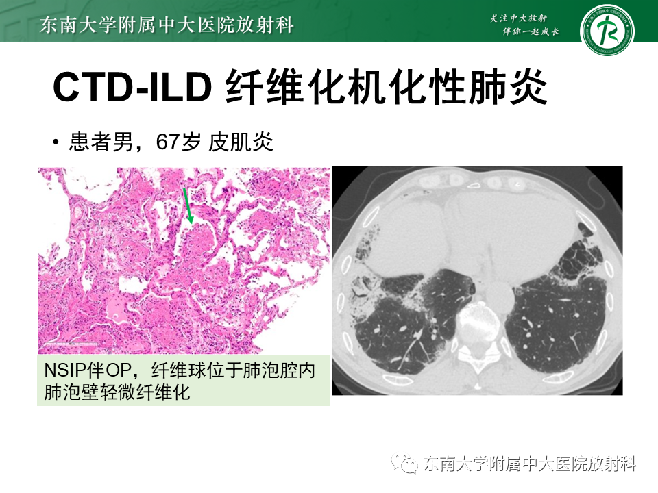 影像PPT - 【PPT】肺间质疾病相关影像鉴别-52