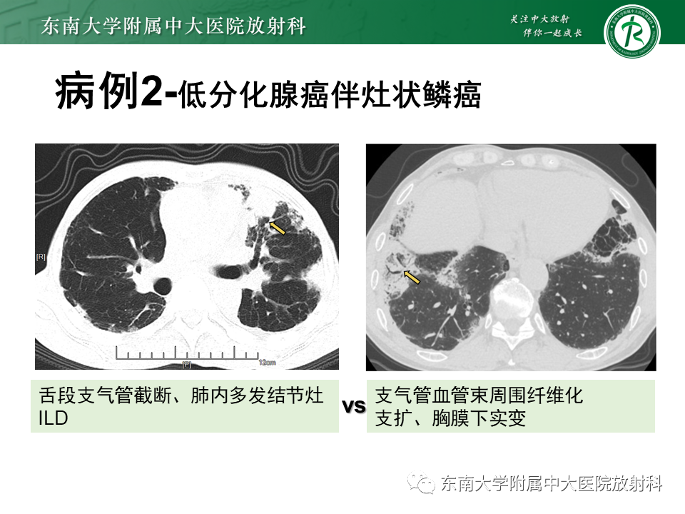 影像PPT - 【PPT】肺间质疾病相关影像鉴别-53