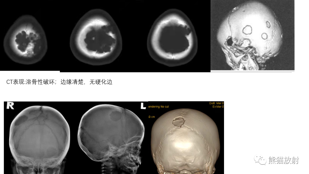 影像PPT - 【病例】颅骨尤文氏肉瘤 VS 颅骨脑膜瘤-45