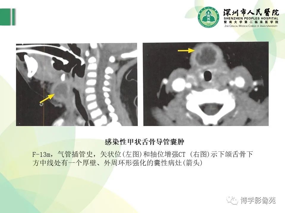 影像PPT - 【PPT】颈部囊性病变-7