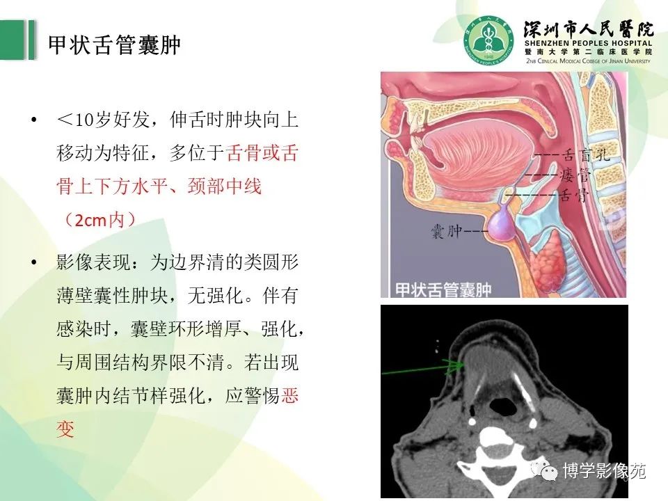 影像PPT - 【PPT】颈部囊性病变-6
