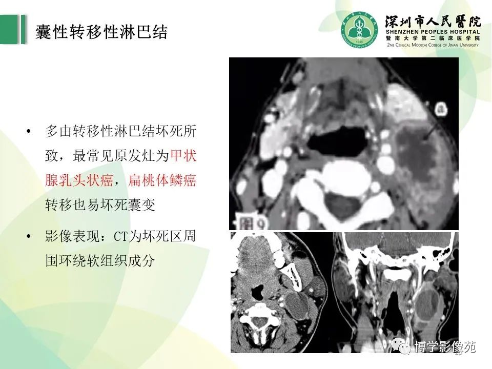 影像PPT - 【PPT】颈部囊性病变-15
