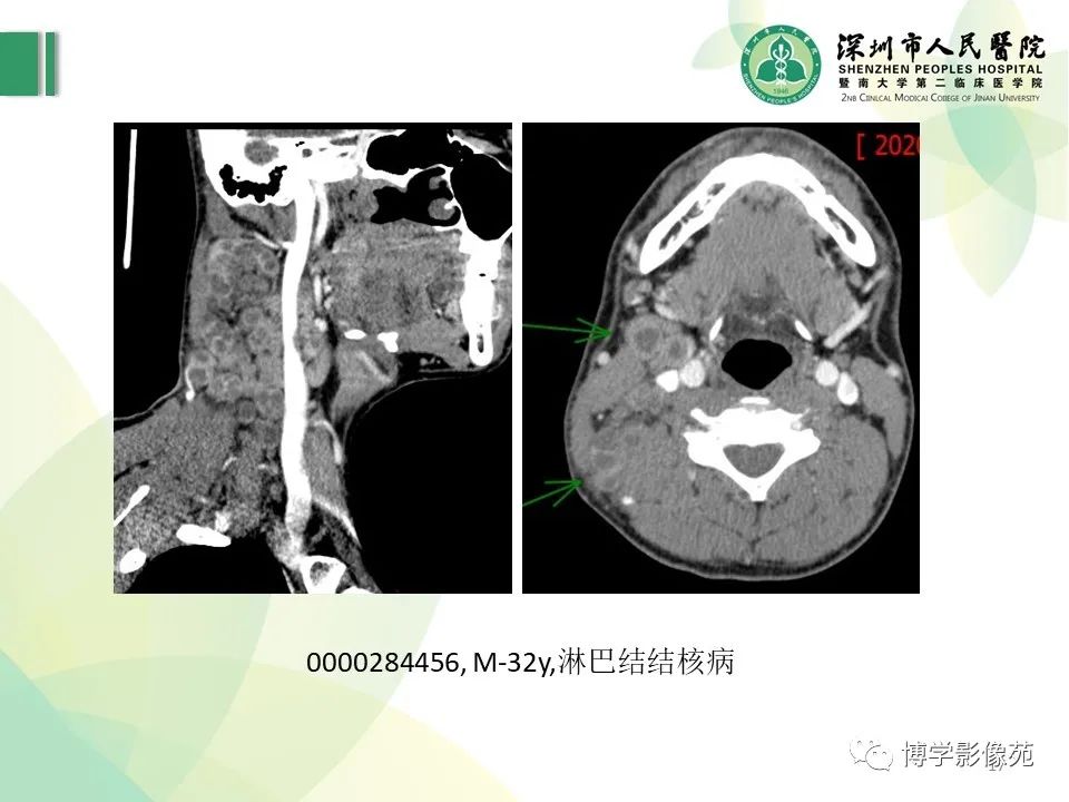 影像PPT - 【PPT】颈部囊性病变-17