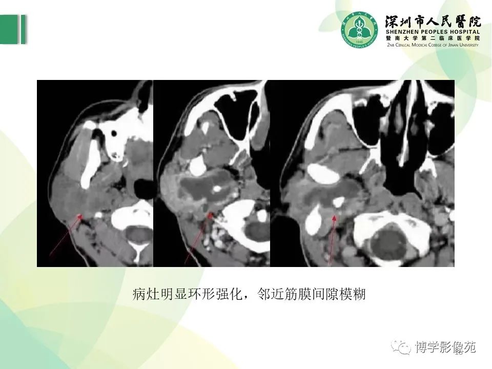 影像PPT - 【PPT】颈部囊性病变-18