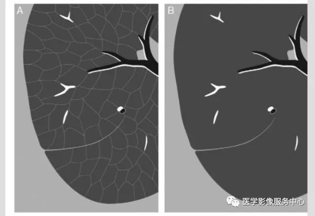 影像PPT - 小气道病变/细支气管炎的分型及影像征象-1 影像PPT - 小气道病变/细支气管炎的分型及影像征象-1
