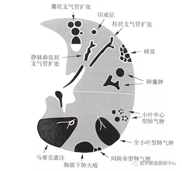 影像PPT - 肺含气囊腔分类、定义及CT诊断思维-2 影像PPT - 肺含气囊腔分类、定义及CT诊断思维-2