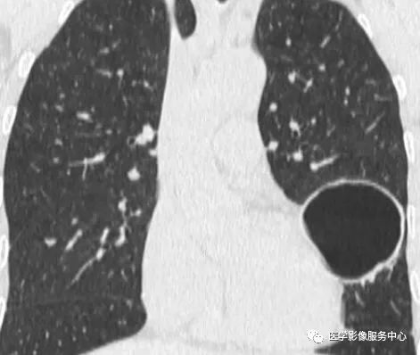 影像PPT - 肺含气囊腔分类、定义及CT诊断思维-3 影像PPT - 肺含气囊腔分类、定义及CT诊断思维-3